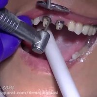 مراحل حذف ونیر قدیمی دندان و جایگزینی با ایمپلنت