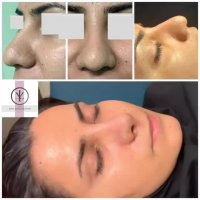 فیلم جراحی بینی گوشتی