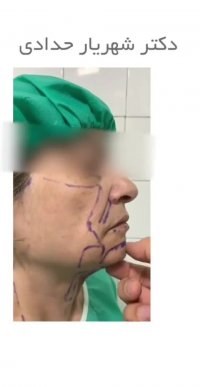 جوانسازی صورت