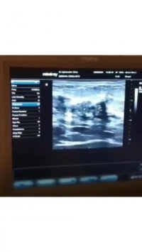 ترشحات خونی از پستان