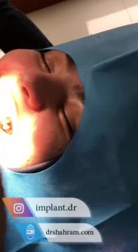 جراحی یک واحد ایمپلنت فوری توسط دکتر شهرام اسعدی