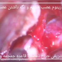 192. فیلم جراحی عصب هشتم با اختلال شنوایی در خانم جوان