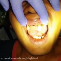 پریودنتیت شدید لثه-دکترمجیدقیاسی دندانپزشک زیبایی مشهد