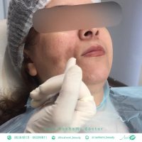 سریعترین درمان فرورفتگی گونه