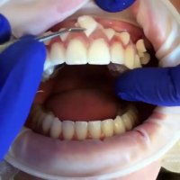 روکش موقت-مرکز فوق تخصصی ایمپلنت پردیس