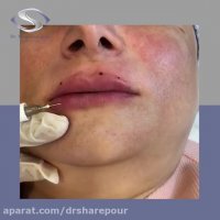 فیلم تزریق فیلر لب