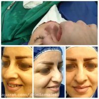 نتیجه جراحی بینی گوشتی