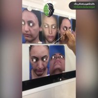 جراحی بینی ترمیمی