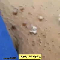 چرا بعد از فیریز کردن زگیل تناسلی دوباره رشد میکند؟