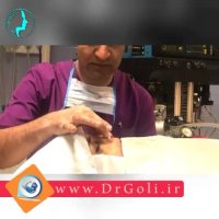 توضیحات دکتر گلی در رابطه با جراحی بینی بلافاصله بعد از عمل | دکتر گلی