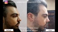 قبل و بعد از جراحی بینی گوشتی | دکتر یحیوی
