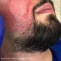 درمان قطعی جای جوش