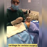 توضیح دکترگلی درمورد غضروف های اضافه انتهای عمل