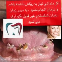 اهمیت روکش دندان