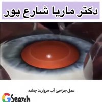 جراحی آب مروارید