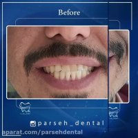 ونیر کامپوزیت