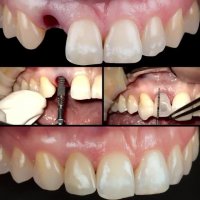 ایمپلنت فوری در یک روز