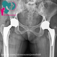 فیلم بعد از جراحی تعویض مفصل لگن