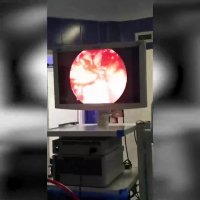 جراحی آندوسکوپی سینوزیت قارچی توسط دکتر شهریار یحیوی