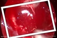 کلسترول گرانولاما