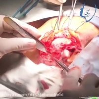 جراحی پاروتید