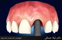 کاشت ایمپلنت دندان
