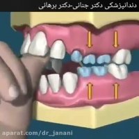 عوارض مکیدن انگشت در کودکان