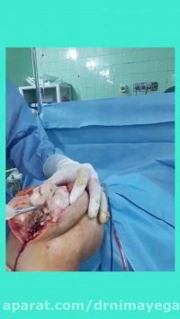 تعویض مفصل زانو در خانم ٧٠ ساله