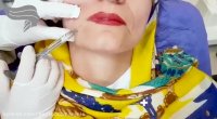 تزریق ژل خط خنده