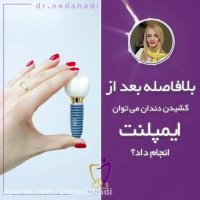 بلافاصله بعد از کشیدن دندان می توان ایمپلنت انجام داد؟