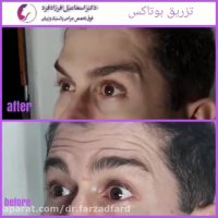 فیلم تزریق بوتاکس