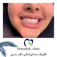 لمینت سرامیکی