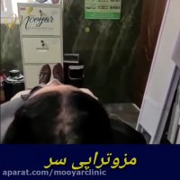 مزوتراپی سر