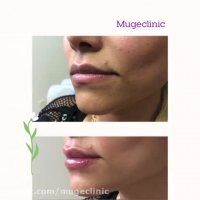 فرم دهی لب با تزریق ژل