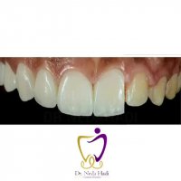 اصلاح طرح لبخند