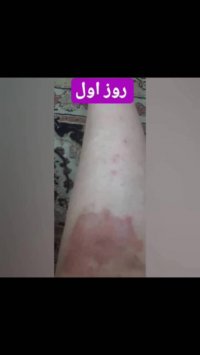 درمان سریع بیماری اگزمای پوستی در طب سنتی