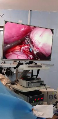 لایو اینستاگرام : جراحی چاقی بای پس امگا در خانم 34 ساله با وزن 134 کیلوگرم