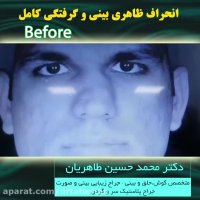 انحراف ظاهری بینی و گرفتگی کامل