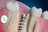 ویدیو جالب در مورد ایمپلنت دندان