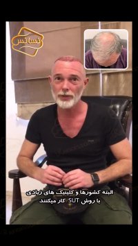 فیلم کاشت مو-کلینیک تخصصی رنسانس