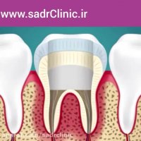 عصب کشی و ترمیم دندان !!!!