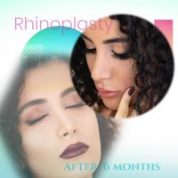 نمونه کار های دکتر شهریار یحیوی بهترین جراح بینی تهران