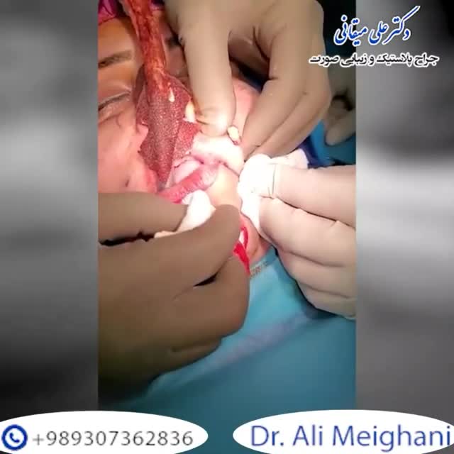 فیلم تخلیه ژل