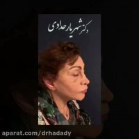 جوانسازی صورت در خانم 78 ساله