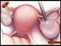 تخمدان پلی‌کیستیک