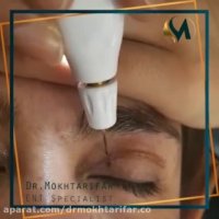 فیلم جراحی پلک از نزدیک