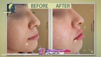 فیلم قبل و بعد از تزریق ژل  لب