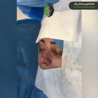 نتیجه جراحی بینی ترمیمی با کمک غضروف دنده خود بیمار
