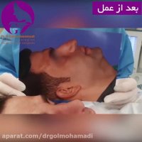 فیلم عمل بینی مردانه