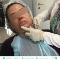 تزریق ژل به چانه